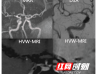 高分辨血管壁MR成像，脑血管病患者的福音